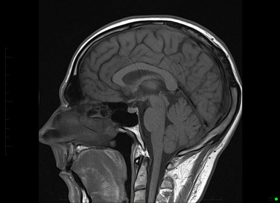 Brain without contrast showing normal enhancement of the ...