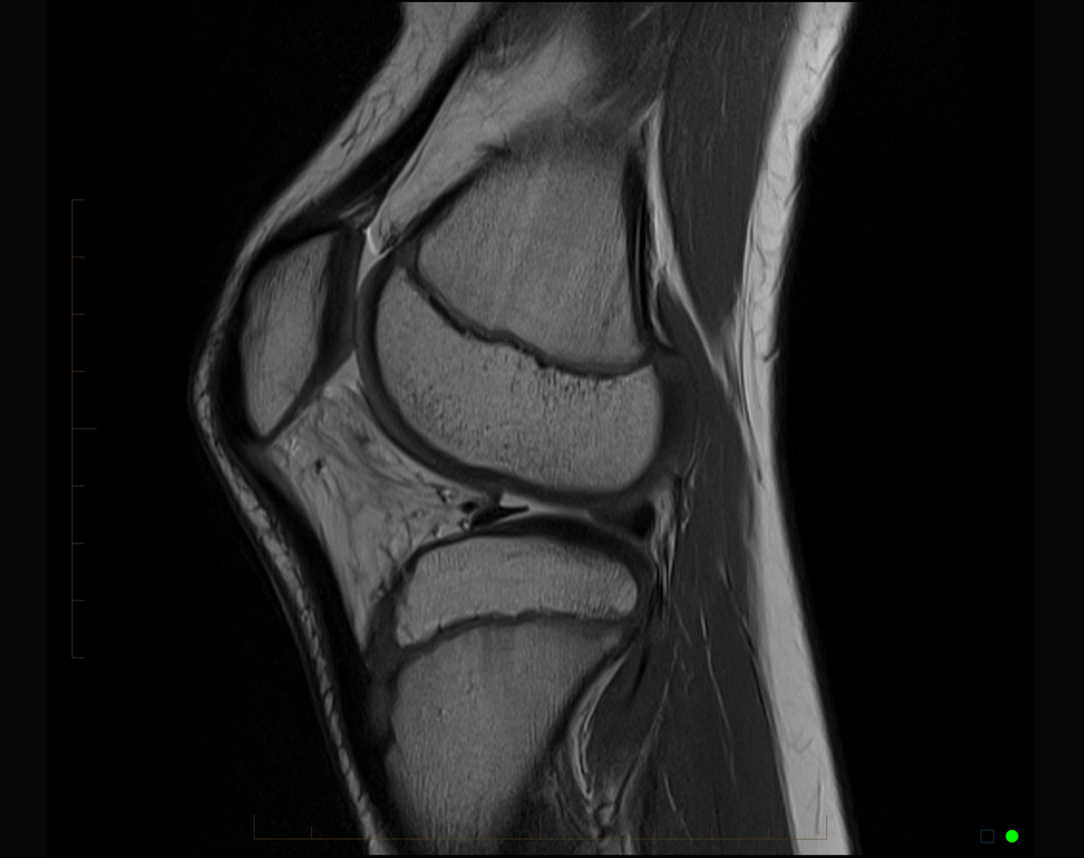 mri child knee