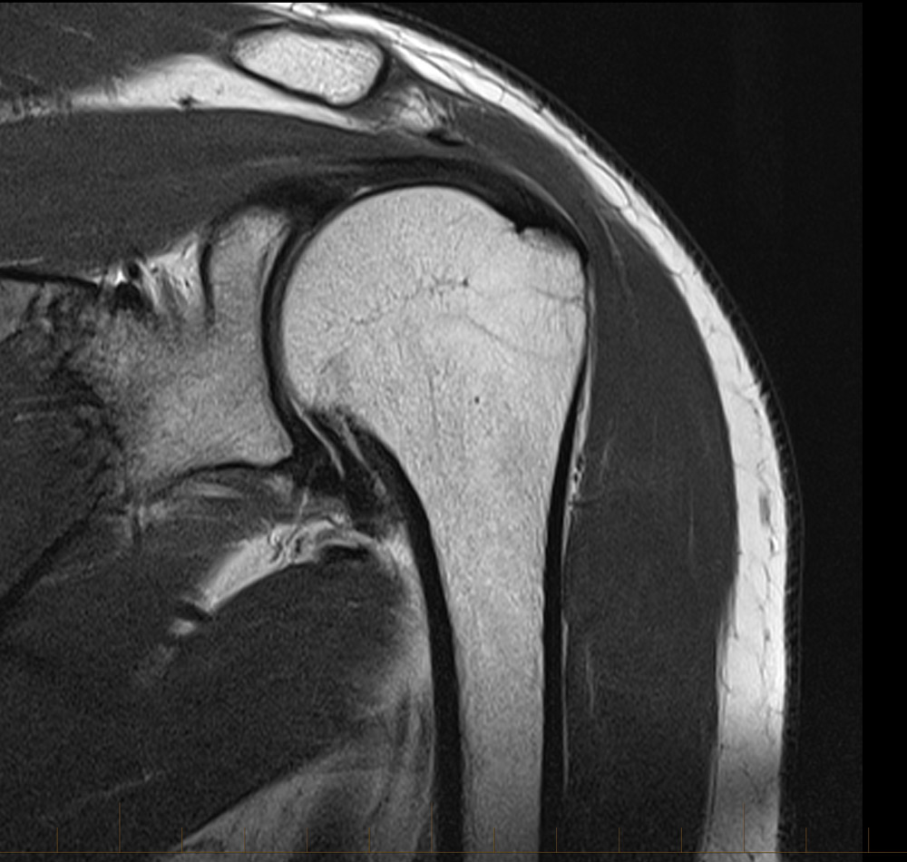 MRI of Shoulder Rotator cuff tear MRI at Melbourne