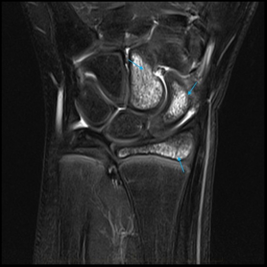 Paediatric MRI of the Wrist bone bruises are seen of the capitate