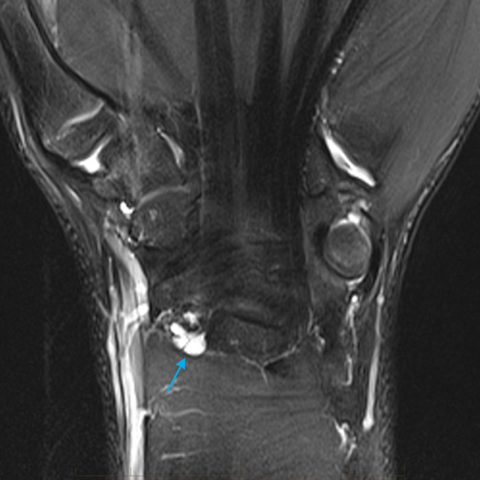 Paediatric MRI Wrist Ganglion Cyst Formation Which Occurs When Increased Fluid In The Joint