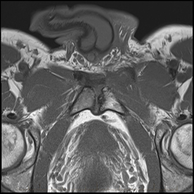 MRI of Sports Injuries Musculoskeletal MRI