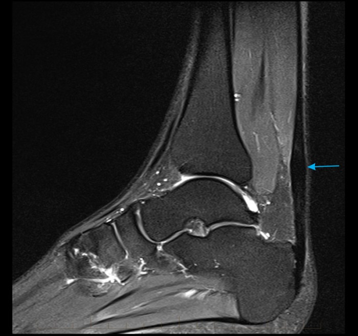 MRI Achilles Tendon Melbourne Radiology