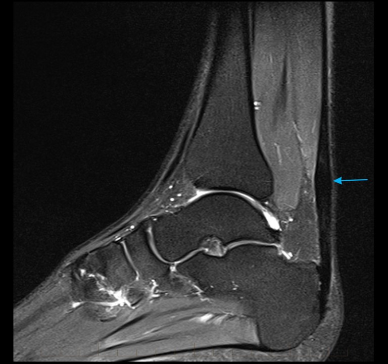 MRI Achilles Tendon - Melbourne Radiology
