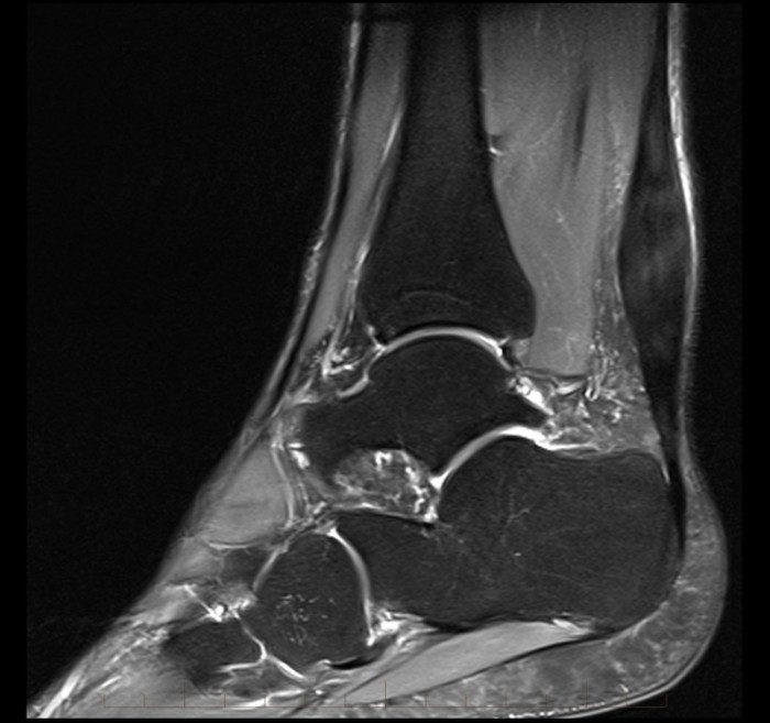 melbournemrileftachillestendonpartialthicknesstear5 MRI at