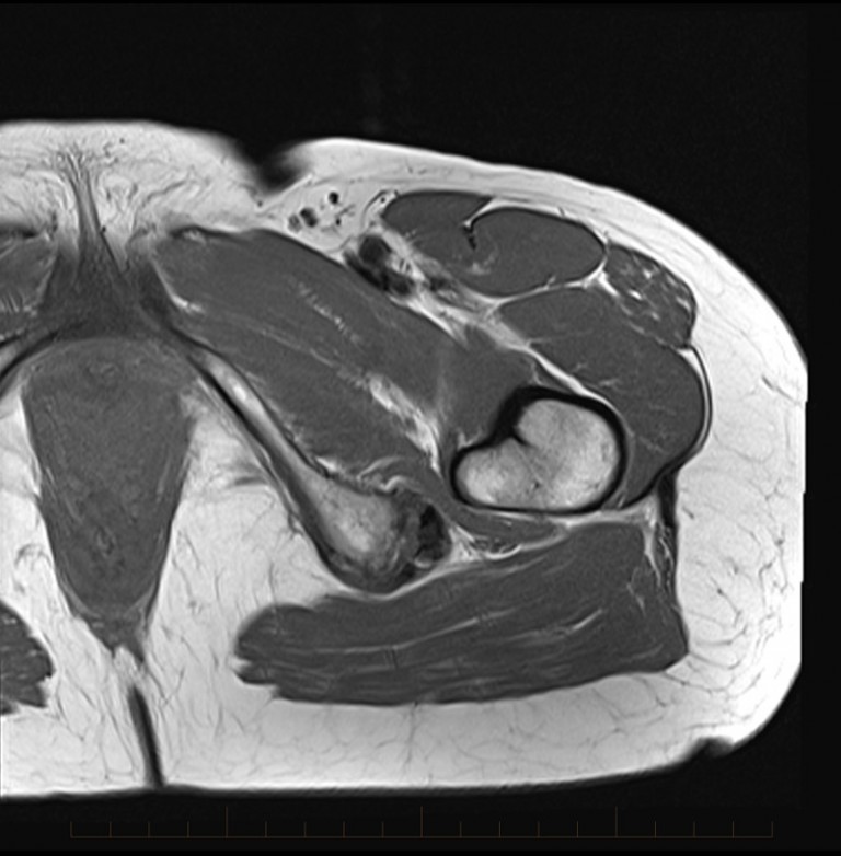 MRI Hamstring bursitis MRI at Melbourne Radiology Clinic