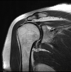 mri-shoulder-supraspinatus-tendon-full-tear-rupture-10 - MRI at