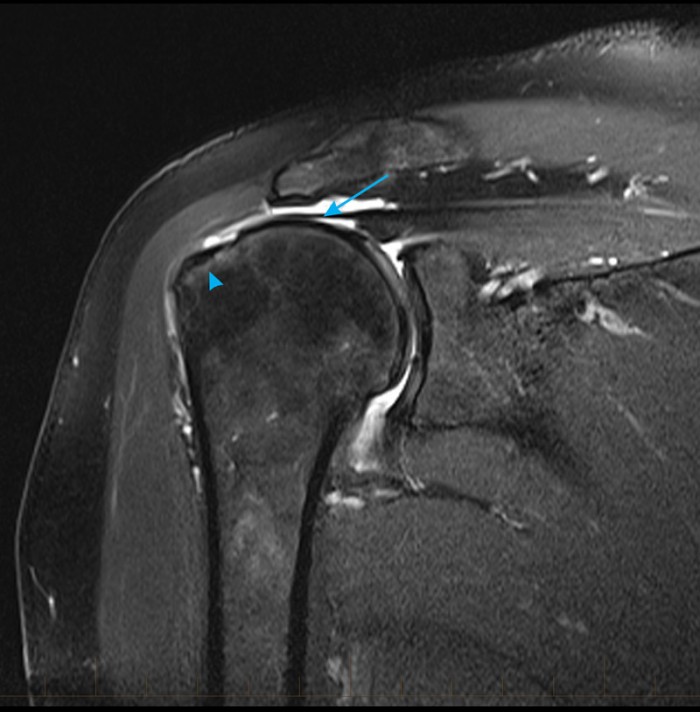 mrishouldersupraspinatustendonfulltearrupture9arrow MRI at