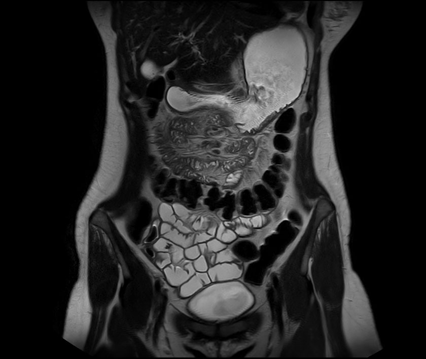 MRI of Small Bowel for Evaluation of Crohn's disease MRI at Melbourne