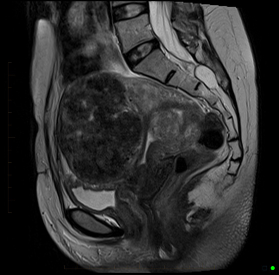 MRI Female Pelvis