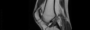 MRI Scan of Knee - Melbourne Radiology Clinic