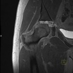 dGEMRIC MRI Scan of the Hip Joint