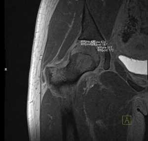 dGEMRIC MRI Scan of the Hip Joint