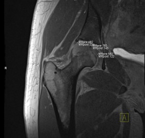 dGEMRIC MRI Scan of the Hip