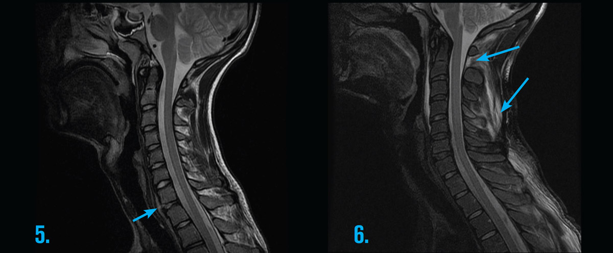 MRI Cervical Spine Radiculopathy - GP Referred MRI