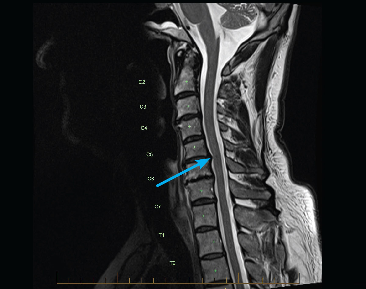 mri cervical spine radiculopathy gp series1