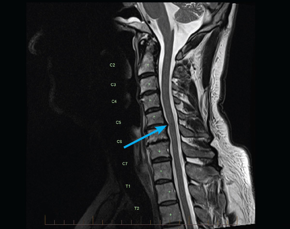 Adult Mri Series Mri Of Cervical Spine Radiculopathy