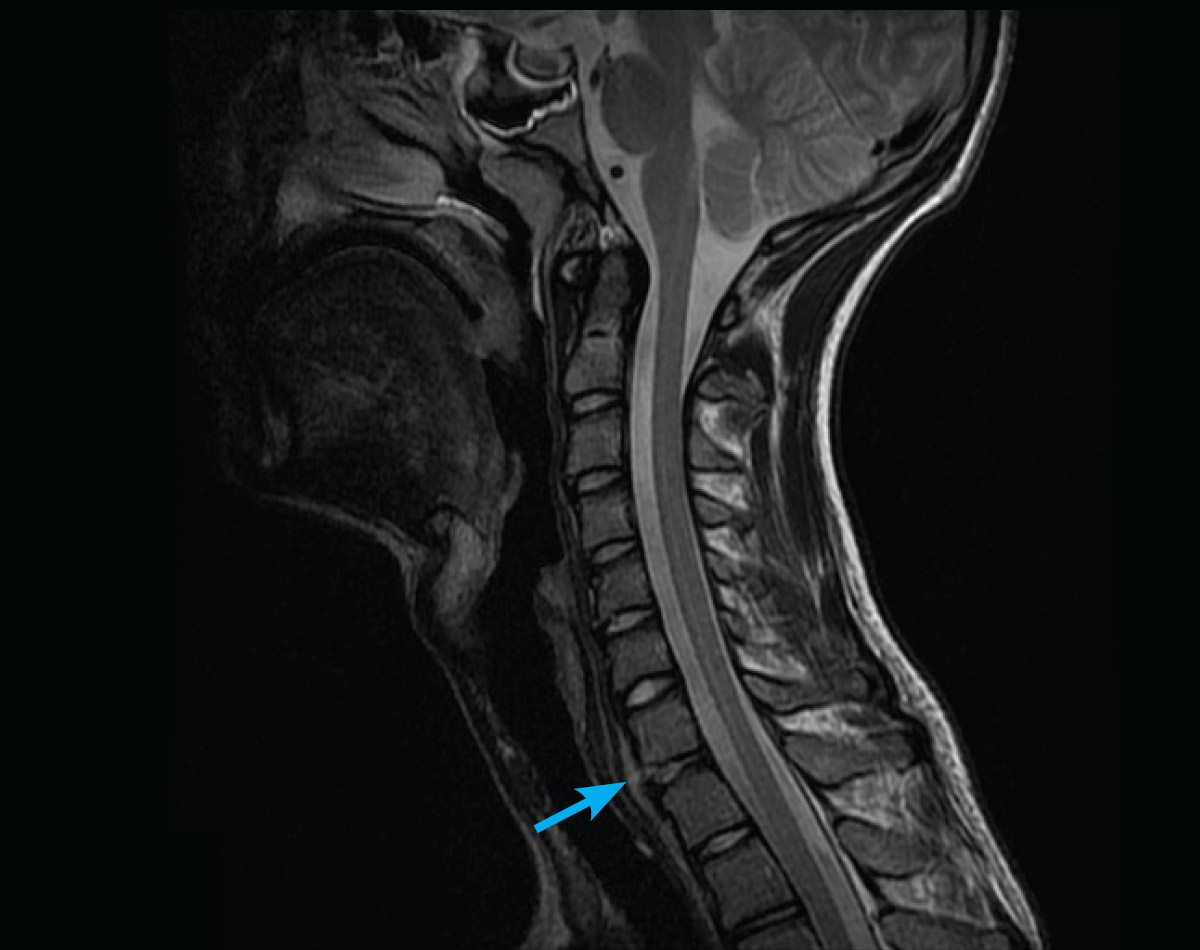 adult-mri-series-cervical-spine-trauma