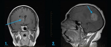 MRI Scan of Head / Brain - Fig 1: Coronal post contrast MRI of the brain in a patient presenting with a headache demonstrates an enhancing mass of the right lateral ventricle (arrow) that was pathologically confirmed to be a primary brain tumour, in this instance a central neurocytoma. Fig 2: Sagittal post contrast MRI of the brain in a patient with a history of melanoma and new onset of seizures demonstrates an enhancing lesion (arrow) in keeping with a solitary metastasis.