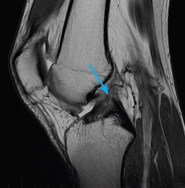 mrikneeacltear MRI at Melbourne Radiology Clinic