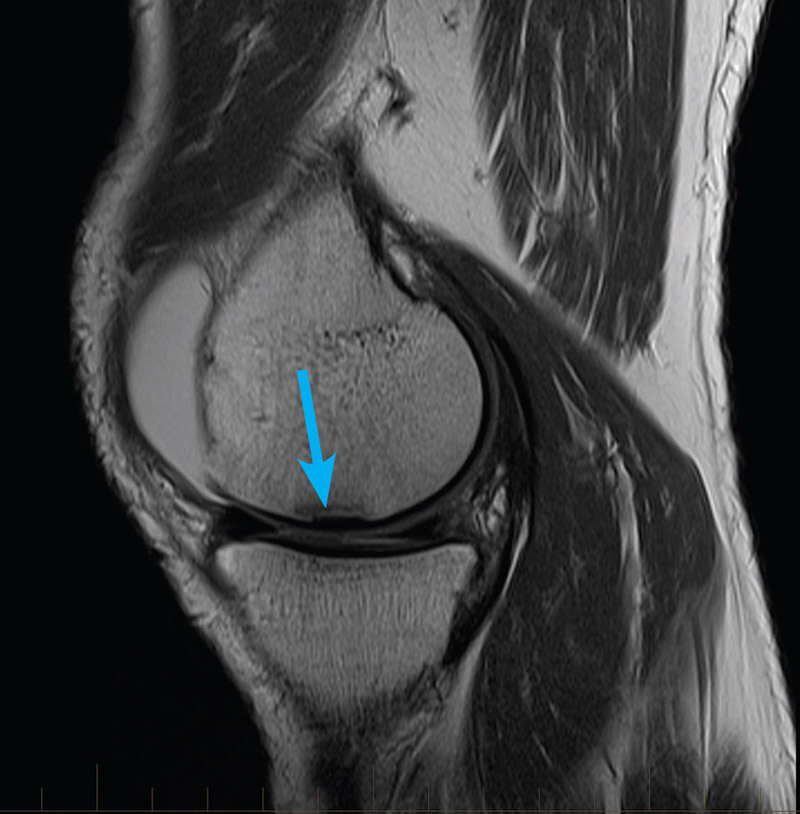 Meniscus Tear Mri Axial View