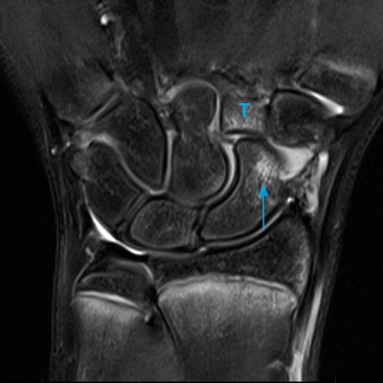 MRI of the wrist demonstrates abnormal bone marrow oedema as bright regains within the scaphoid (arrow) and trapezoid bones (T), in keeping with bone contusions or bruises