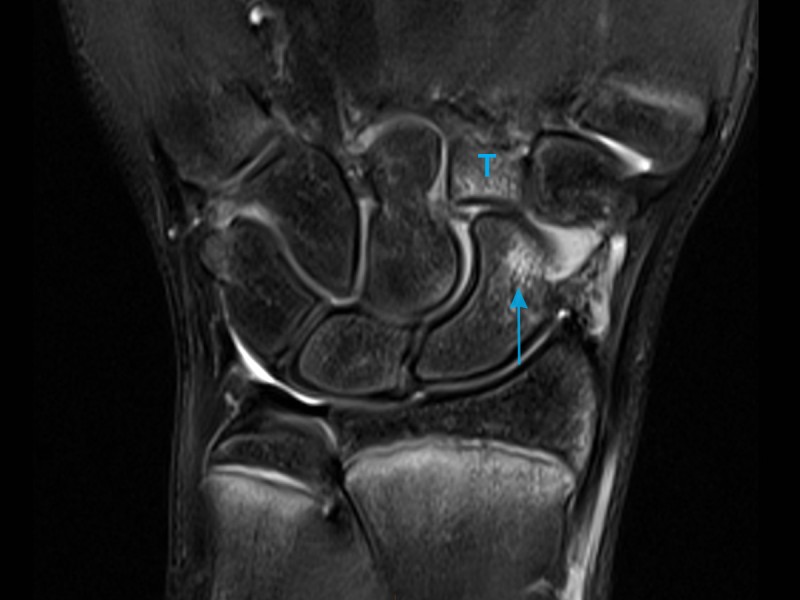 MRI of the wrist demonstrates abnormal bone marrow oedema as bright regains within the scaphoid (arrow) and trapezoid bones (T), in keeping with bone contusions or bruises