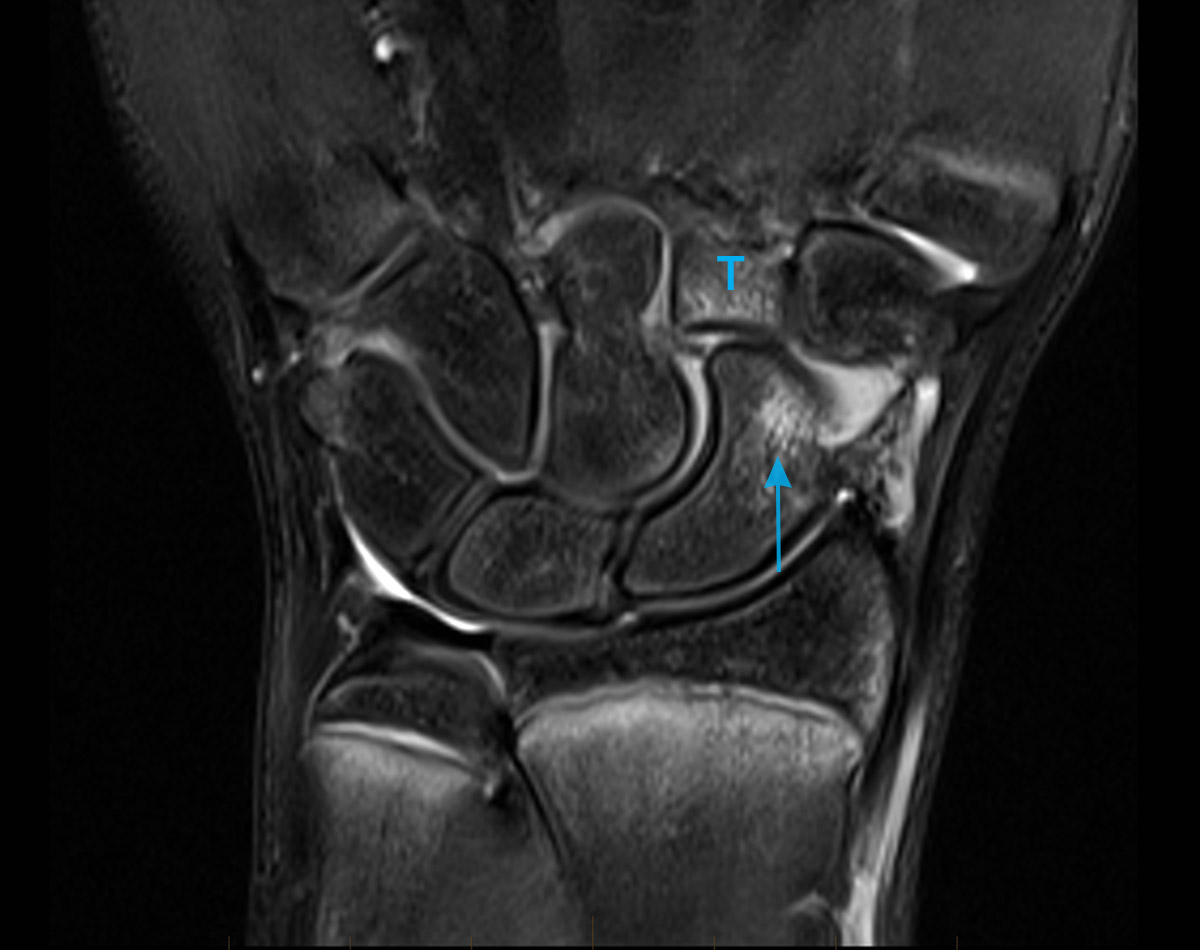 MRI of the wrist demonstrates abnormal bone marrow oedema as bright regains within the scaphoid (arrow) and trapezoid bones (T), in keeping with bone contusions or bruises