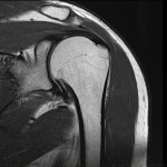 MRI of Shoulder - Rotator cuff tear