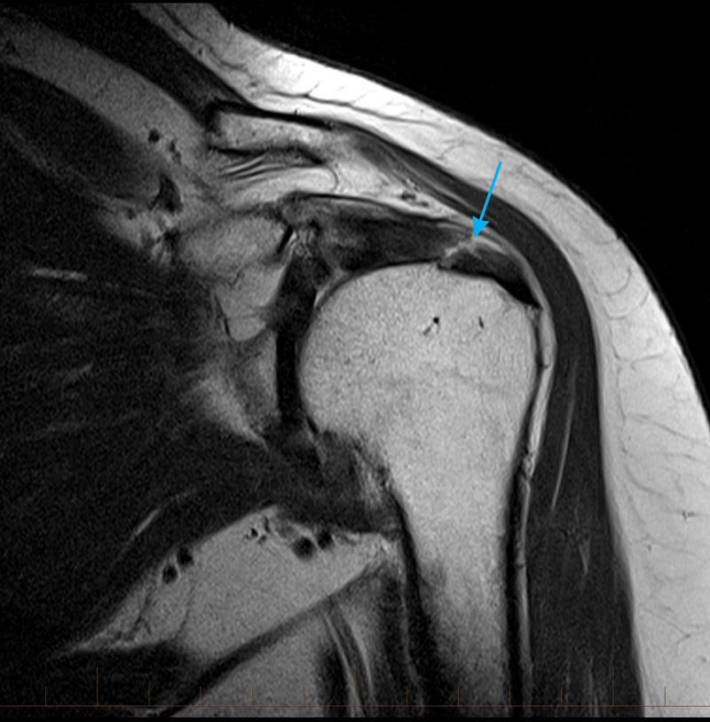 mrishouldersupraspinatustendontear MRI at Melbourne Radiology Clinic