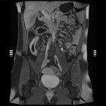 MRI of Small Bowel