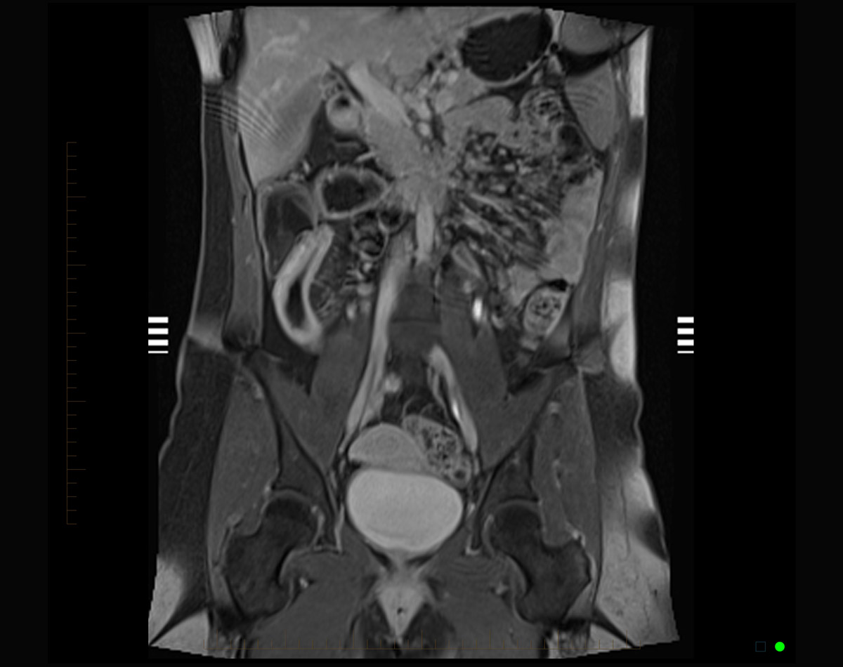 MRI of Small Bowel
