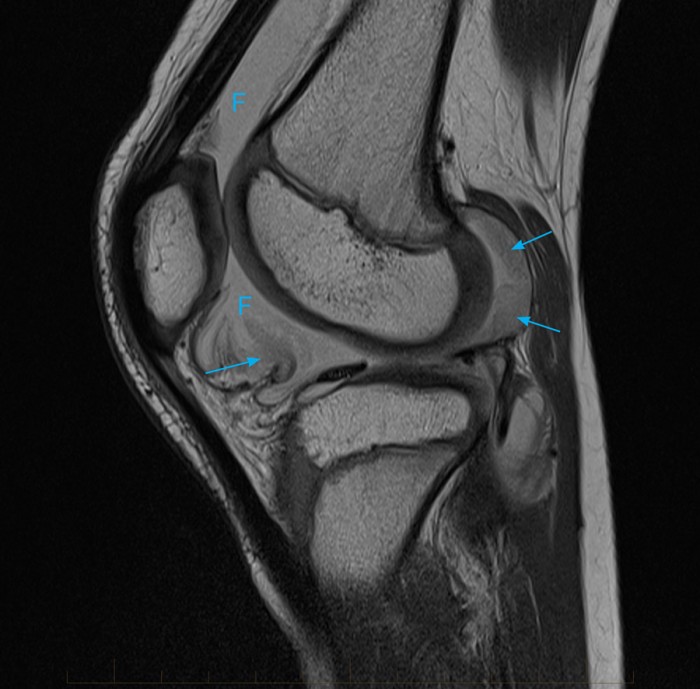 11juvenilechronicarthritismriknee MRI at Melbourne Radiology Clinic
