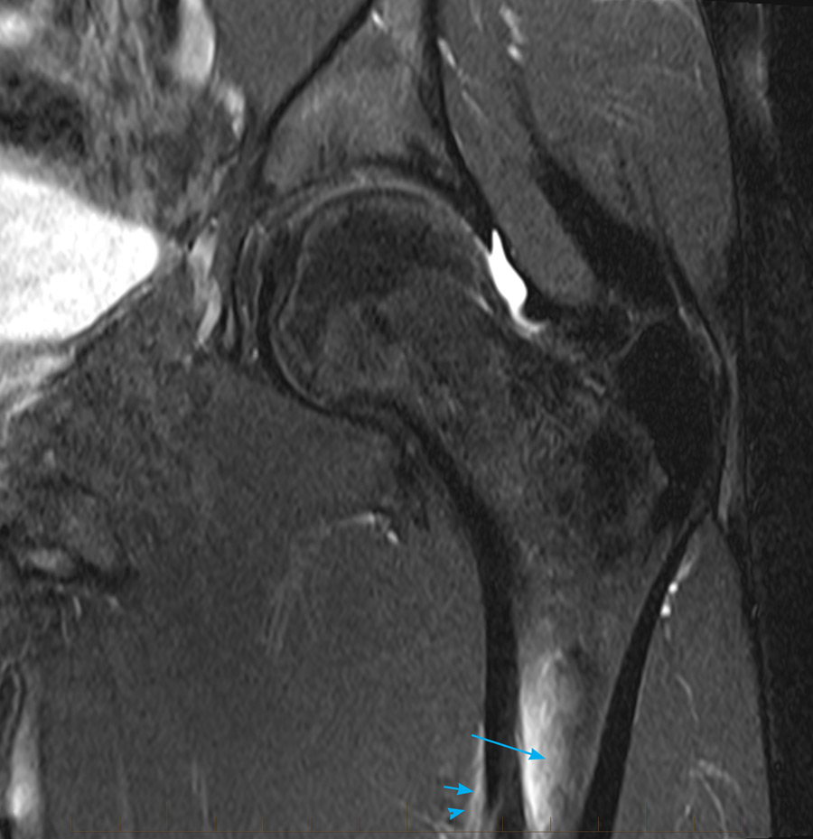 11stressfracturemrihippaediatricmelbourne MRI at Melbourne