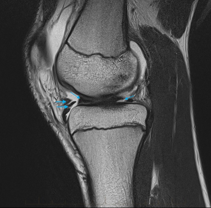 MRI Scan of Knee in a Child bucket handle tear MRI at Melbourne