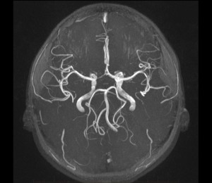 Paediatric MRI Scan of Head - Normal MR angiogram, demonstrating normal arteries of the brain, known as the circle of Willis.