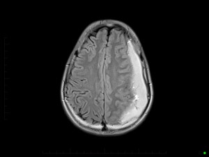 MRI Brain - Axial image