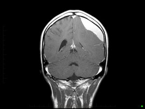 MRI Brain - Coronal image