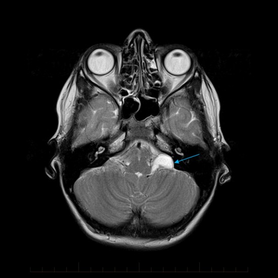 MRI of a Child's Brain - demonstrates the presence of a left sided benign arachnoid cyst (arrow) located at the cerebellopontine angle, Melbourne Radiology Clinic