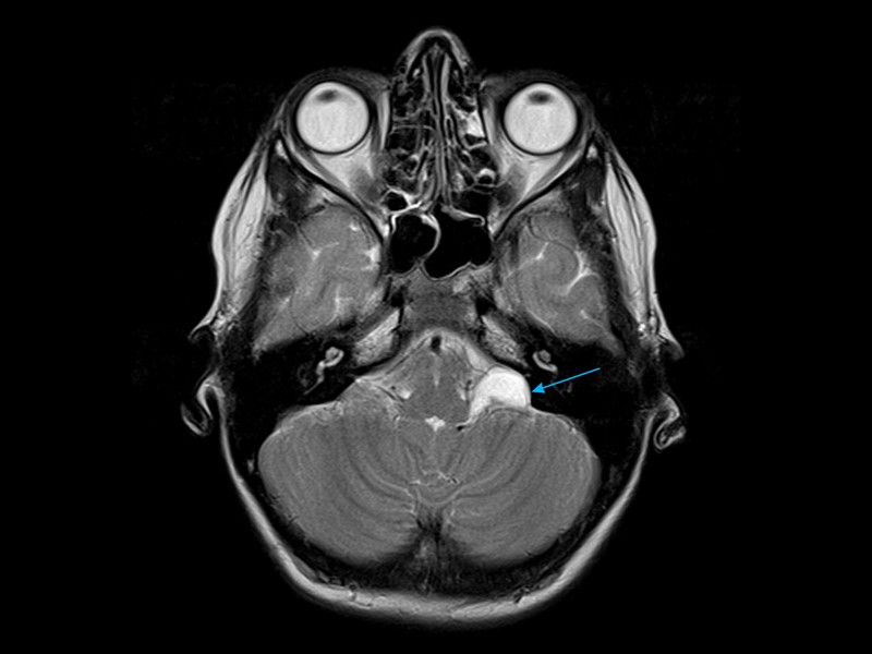 MRI of a Child's Brain - demonstrates the presence of a left sided benign arachnoid cyst (arrow) located at the cerebellopontine angle, Melbourne Radiology Clinic