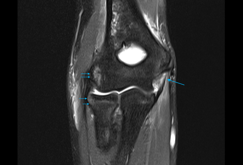 MRI Scan of a Child's Elbow following a fall and subluxation - medial collateral ligament sprain and bone contusions opposite