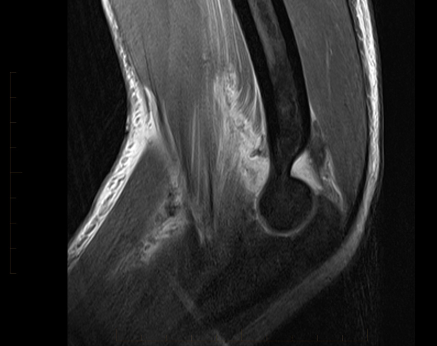 MRI of Elbow in 15 YO male with tearing of the joint capsule, which is typical for an episode of instability.