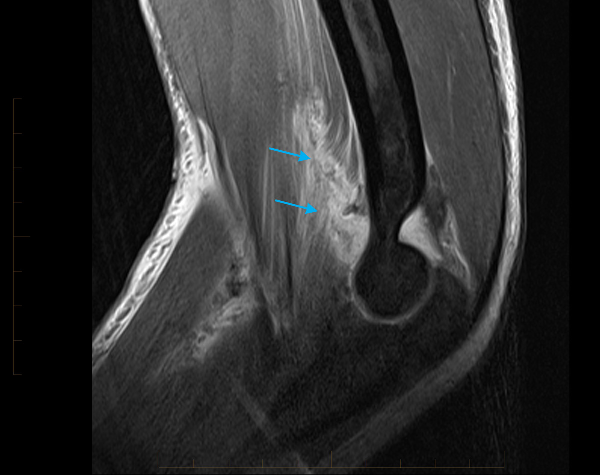 MRI of Elbow in 15 YO male with tearing of the joint capsule, which is typical for an episode of instability.