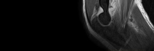 MRI of the Paediatric Elbow