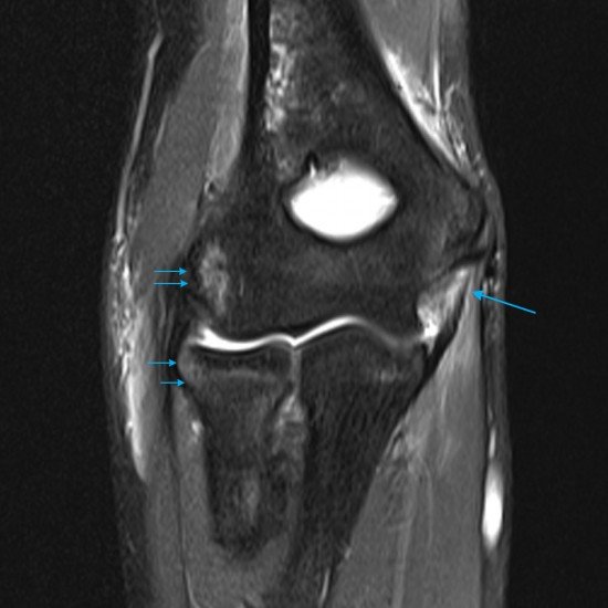 MRI GP Series Paediatric Elbow