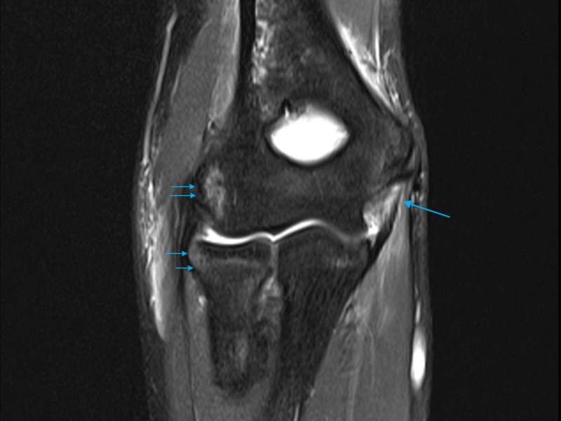 MRI GP Series Paediatric Elbow