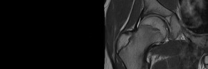 MRI Scan of the Paediatric Hip - Melbourne Radiology Clinic