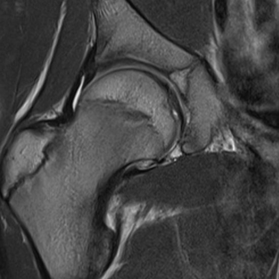 MRI HIP Paediatric Patient