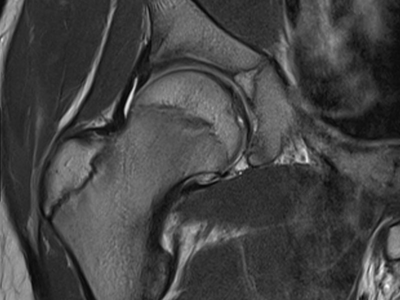 MRI HIP Paediatric Patient