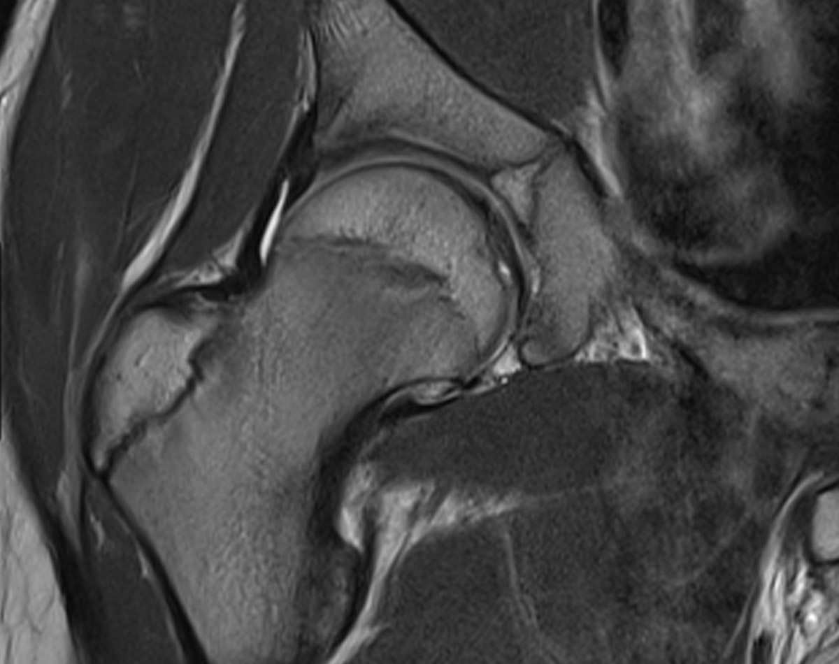 MRI HIP Paediatric Patient